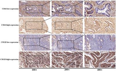 The prognostic value of co-expression of stemness markers CD44 and CD133 in endometrial cancer